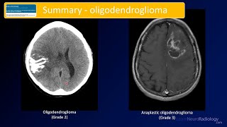 Emergency Imaging of Brain Tumors Oligodendrogliomas amp Others [upl. by Aisya]