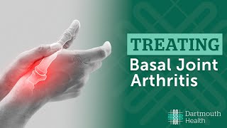 Basal Joint Arthritis [upl. by Imas]