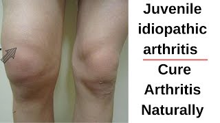 Juvenile idiopathic arthritis  Cure Arthritis Naturally [upl. by Inalem697]