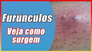 Como surgem os furúnculos  Sintomas Tratamento e Prevenção [upl. by Ardnasirk971]