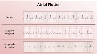 Intro to EKG Interpretation  Overview of Tachyarrhythmias [upl. by Tabbie]