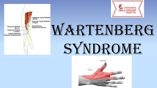 Wartenberg Syndrome  Superficial Radial Nerve Compression Neuropathy [upl. by Telfore175]