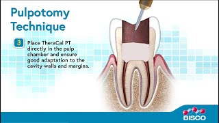 TheraCal PT Whiteboard Video  Discover Our Pulpotomy Treatment [upl. by Tniassuot589]