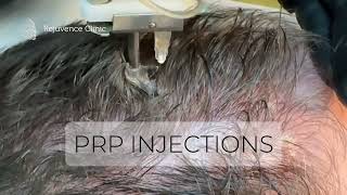 PRP for Hair  Level III Angel Arthrex rejuvenceclinic91 [upl. by Mintz949]