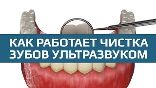 Ультразвуковая чистка зубов Процедура проведения чистки зубов ультразвуком [upl. by Nylodnew993]