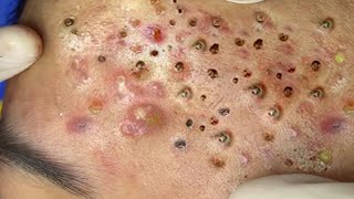 Big Cystic Acne Blackheads Extraction Blackheads amp Milia Whiteheads Removal Pimple Popping  2313 [upl. by Felten]