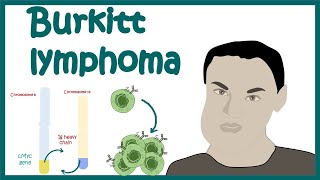 Burkitt’s Lymphoma  Aggressive BCell NonHodgkin’s Lymphoma  Cellular basis of Burkitt’s Lymphoma [upl. by Yasu]