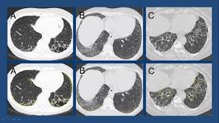 Fibrosis Pulmonar por tomografia computada [upl. by Opiak]