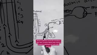 HORNER SYNDROME  lateral medullary syndrome lung apex tumor internal carotid dissection [upl. by Alleiram640]