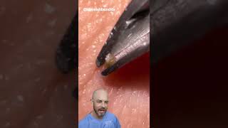 This ingrown hair removal is short and sweet credit blemishbandits on TT doctor satisfying [upl. by Pastelki]