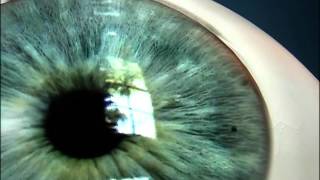 Laser Iridotomy for Angle Closure Glaucoma [upl. by Skippy]