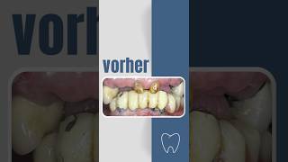 Vorher 😕 Nachher 🦷🙏 shorts zahnarzt dental [upl. by Leugar]