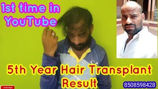 5 Years Hair Transplant Result First 5years result video Upload in MediaTamil Hair Transplant [upl. by Otiragram]