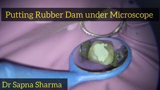 Rubber Dam Placement on Upper Molar  Rubber Dam Application under Microscope [upl. by Pogue760]