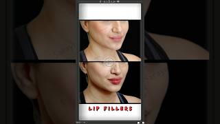 Get Fuller Symmetrical Lips By Dr Adarsh Tripathi  Sarayu Clinics fillers [upl. by Vories]