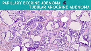 Papillary Eccrine AdenomaTubular Apocrine Adenoma Dermpath in 5 Minutes [upl. by Enenej684]