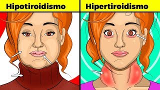 Síntomas de tiroides en mujeres hipotiroidismo e hipertiroidismo signos causas y tratamiento [upl. by Sillihp]