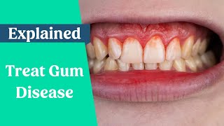 How to treat gum disease [upl. by Maighdiln509]