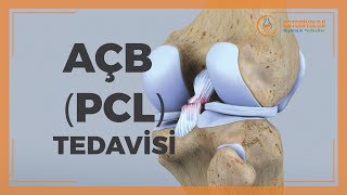 ARKA ÇAPRAZ BAĞ PCL KOPUĞU VE SEÇKİN AÇB TEDAVİSİ [upl. by Aicele711]