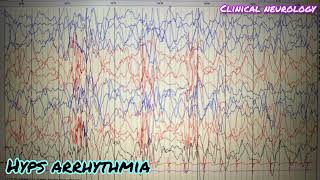 Hyps arrhythmia EEG hypsarrhythmia eeg neurology medicine [upl. by Ynner615]