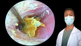 Amazing Ear Cleaning Deep Wax Removalearearwax earwaxremovalearwaxcleaningrelaxasmr [upl. by Allecram239]