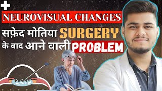 Neurovisual changes after cataract Surgery  Cataract surgery [upl. by Arivle]