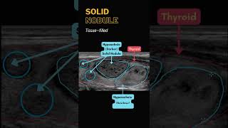 Thyroid Nodule Ultrasound  Cystic Solid Complicated Calcifications [upl. by Anaile]