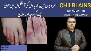 Chilblains Inflammation Sardion mean Hathon Paon ki Unglion Mean Ratt Jamnachilblains [upl. by Nesta]