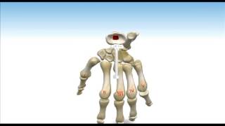 ReMotion™ Total Wrist Arthroplasty  Animated Surgical Technique [upl. by Ayital]