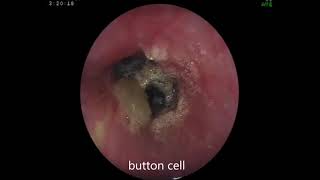 Button Cell In Esophagus  Endoscopic Management Of GRED  Dr Shrikant Kurhade [upl. by Onimixam]