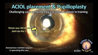 CataractCoach 1241 ACIOL placement and pupilloplasty after trauma ruptured globe IOFB [upl. by Katina]