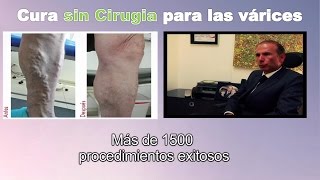 Cura para venas varices SIN CIRUGIA en Bogota Colombia  Tratamiento Ulceras varicosas Linfedema [upl. by Deering]