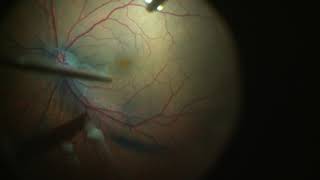 Fovea Sparing ILM Peeling for Vitreomacular Traction with Foveal Detachment [upl. by Feliza]