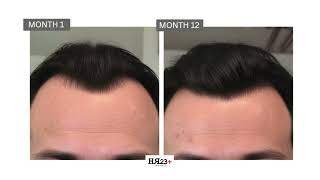 HR23® Hair Loss Treatment Plan  Male Case Study Before and After Results [upl. by Reld713]