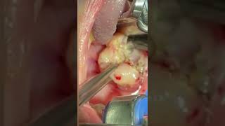 Watch A Real Intracapsular Tonsillectomy Surgery with Expert Explanation [upl. by Rosse]