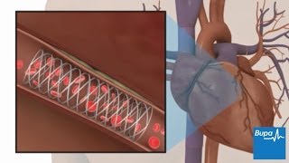 How coronary angioplasty is carried out  Bupa Health [upl. by Fellner139]