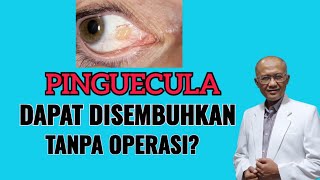 Apakah Pinguecula Bisa Disembuhkan Tanpa Operasi  dr Basuki Rokhmad SpM [upl. by Ennasus]