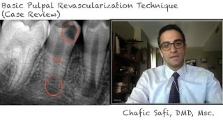 Basic Pulpal Revascularization Case Review with Dr Chafic Safi [upl. by Nautna]