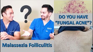 Fungal acne Malassezia folliculitis versus Comedonal acne [upl. by Camille417]