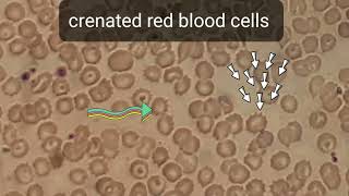 Crenation in blood film smear shows numerous of Burr cells or crenated red blood cells echinocytes [upl. by Calypso]