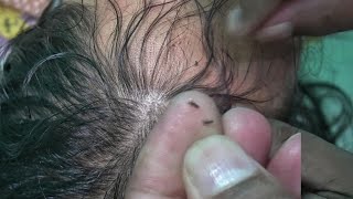 Lice and Nits Picking with Nails  ASMR LICE POPPING SOUNDS [upl. by Neddra199]