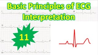 Basic Principles of ECG Interpretation  11 [upl. by Relyuhcs]