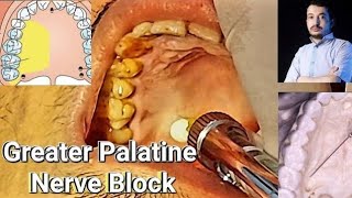 Local Anesthesia Greater Palatine Nerve Block Technique greater Palatine nerve block [upl. by Nauj]