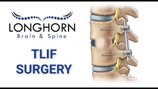 Longhorn Brain and Spine  Roboticassisted minimally invasive TLIF [upl. by Elleirua857]