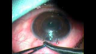 Glaucoma Surgery Conjunctival Closure Of Fornix Based Flap In Trabeculectomy By Dr Sudhir Singh 64 [upl. by Crofton]