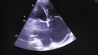 Dextrocardia situs inversus with Lutembacher Syndrone [upl. by Atteuqaj]