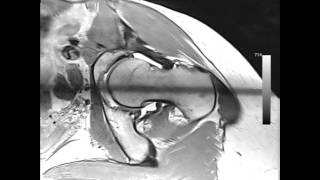 RMN com contraste intraarticular permite detectar lesões na cartilagem e no labrum [upl. by Aicilaanna]