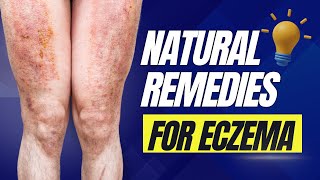 NATURAL REMEDIES FOR ECZEMA [upl. by Cassandry]