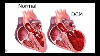 IM Cardiology 16 Cardiomyopathies Dilated cardiomyopathy DCM [upl. by Yltsew]