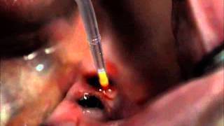 Treating PeriImplant Mucositis [upl. by Anyr]